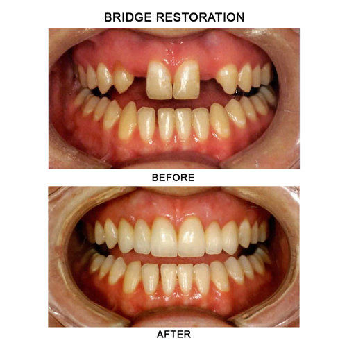 Before & After Precision Dental NYC Precision Dental NYC