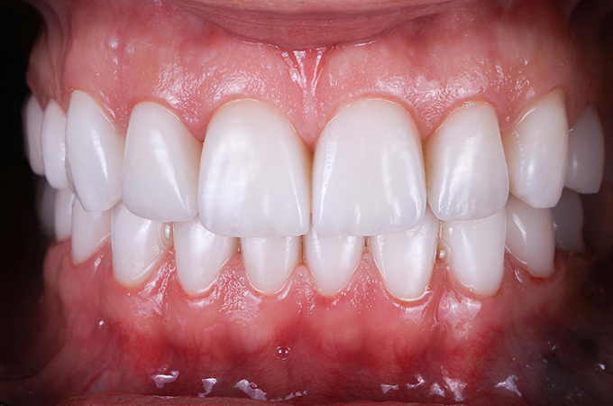 Cosmetic Dentistry Procedure - Placing a Single Dental Implant