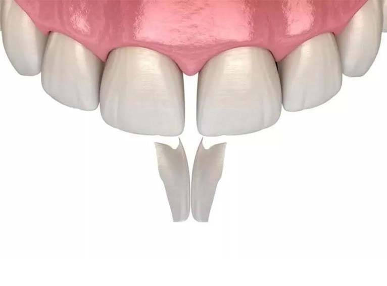 Dental Bonding In Astoria Composite Bonding Queens NY Dental Bonding In Astoria Composite Bonding Queens NY