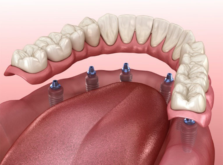 Full Mouth Dental Implants in Astoria and Bayside, Queens NY