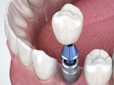 Dental Implants