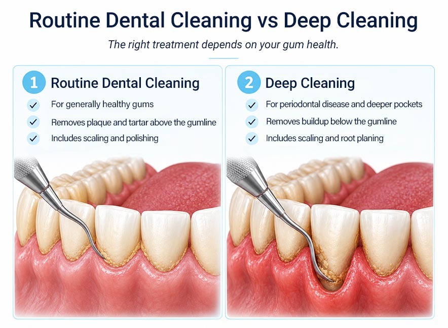 Routine dental cleaning vs deep teeth cleaning showing plaque and tartar removal above and below the gumline